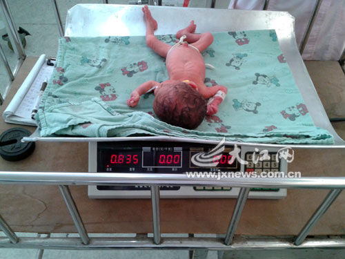女子怀孕不足27周早产 袖珍婴儿不足1公斤(图